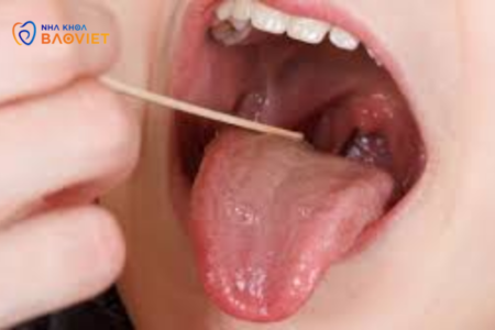 Bệnh Khoang Miệng: Làm Thế Nào Để Phát Hiện Và Điều Trị Sớm?
