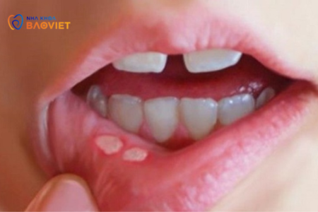 Bệnh Khoang Miệng: Làm Thế Nào Để Phát Hiện Và Điều Trị Sớm?