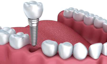 Cấy Ghép Răng Implant Có Đau Không?