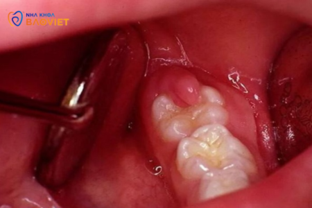 Lưu ý để trành nhiễm trùng khi nhổ răng
