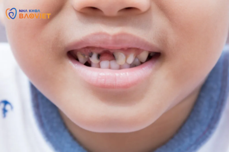Nguyên nhân và cách phòng ngừa sâu răng sữa ở trẻ