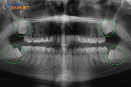Tầm Quan Trọng Của Chẩn Đoán Hình Ảnh Trong Phân Tích Răng Khôn
