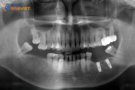 Tầm Quan Trọng Của Chẩn Đoán Hình Ảnh Trong Phân Tích Răng Khôn