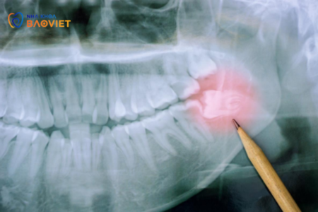 Tầm Quan Trọng Của Chẩn Đoán Hình Ảnh Trong Phân Tích Răng Khôn