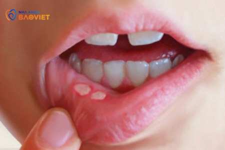 Bệnh Lở Miệng Do Stress: Làm Sao Để Giảm Triệu Chứng?
