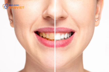 Cách Phục Hồi Răng Bị Ố Vàng Lâu Năm