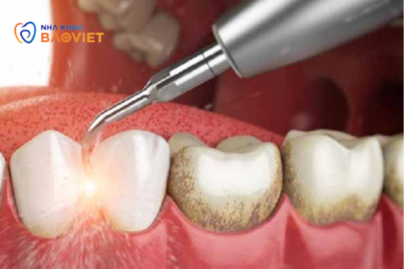 Có nên tự cạo vôi răng tại nhà không? Những rủi ro cần biết