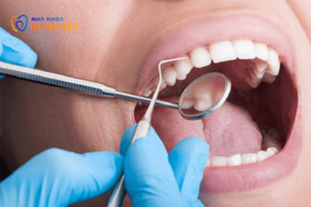 Có nên tự cạo vôi răng tại nhà không? Những rủi ro cần biết