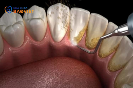 Có nên tự cạo vôi răng tại nhà không? Những rủi ro cần biết