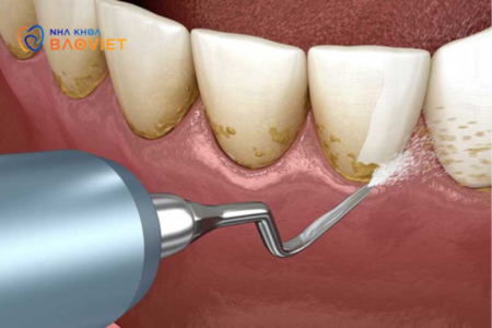 Có nên tự cạo vôi răng tại nhà không? Những rủi ro cần biết