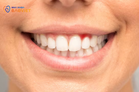 Răng Miệng Của Tuổi Dậy Thì: Làm Sao Để Ngăn Ngừa Mụn Răng Và Viêm Nướu?