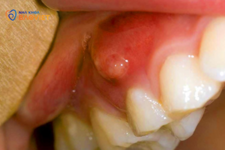 Răng Miệng Của Tuổi Dậy Thì: Làm Sao Để Ngăn Ngừa Mụn Răng Và Viêm Nướu?