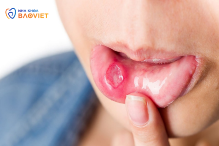 Loét Miệng: Phòng Ngừa Và Điều Trị Dứt Điểm