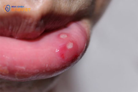 Loét Miệng: Phòng Ngừa Và Điều Trị Dứt Điểm
