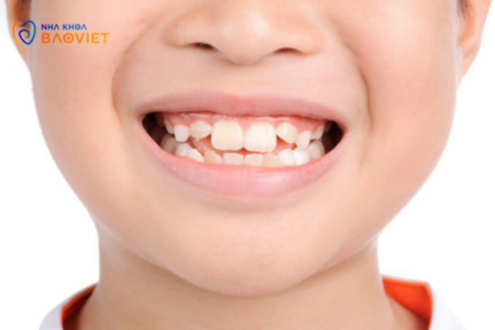 Ngăn Ngừa Răng Vĩnh Viễn Mọc Lệch Ở Trẻ Nhỏ