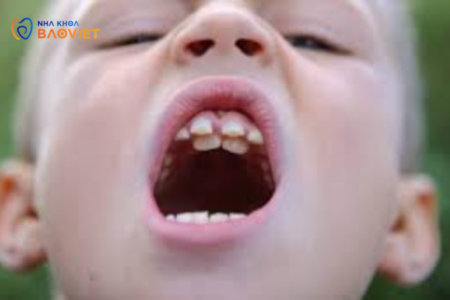 Ngăn Ngừa Răng Vĩnh Viễn Mọc Lệch Ở Trẻ Nhỏ