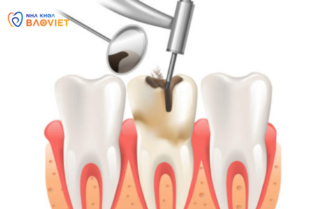 Nhiễm Trùng Tủy Răng: Khi Nào Cần Can Thiệp?