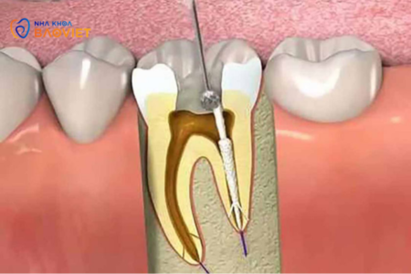 Nhiễm Trùng Tủy Răng: Khi Nào Cần Can Thiệp?