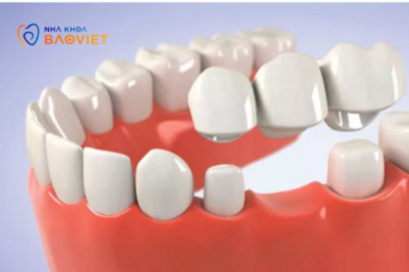 Quy trình làm cầu răng sứ diễn ra như thế nào?
