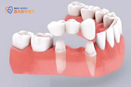Quy trình làm cầu răng sứ diễn ra như thế nào?