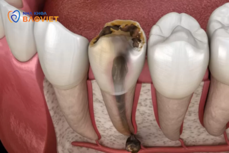 Răng chết tủy là gì? Nguyên nhân và cách điều trị