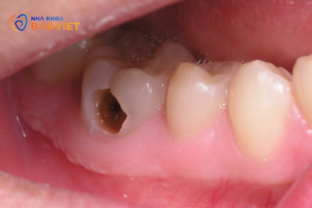 Răng chết tủy là gì? Nguyên nhân và cách điều trị