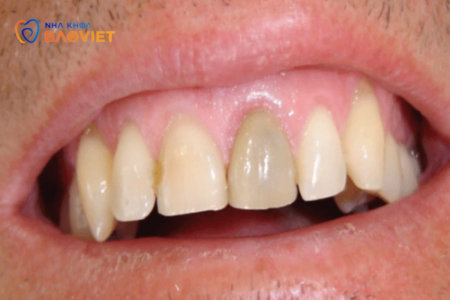 Răng chết tủy là gì? Nguyên nhân và cách điều trị