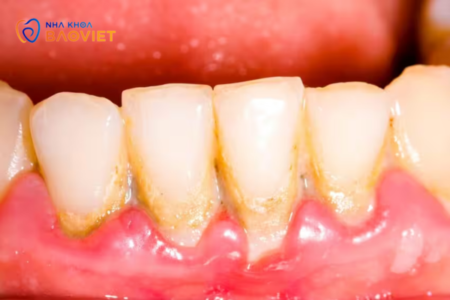 Sự khác biệt giữa mảng bám răng và cao răng