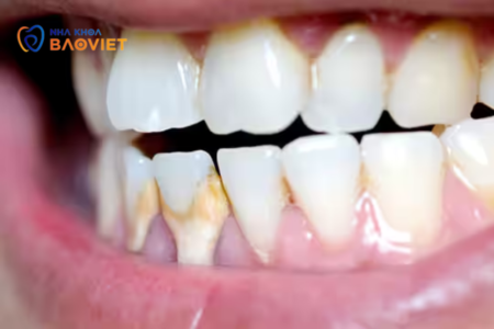 Sự khác biệt giữa mảng bám răng và cao răng