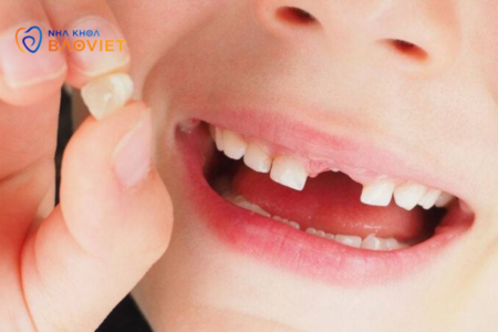 Thời điểm nào thì nên thay răng sữa cho bé
