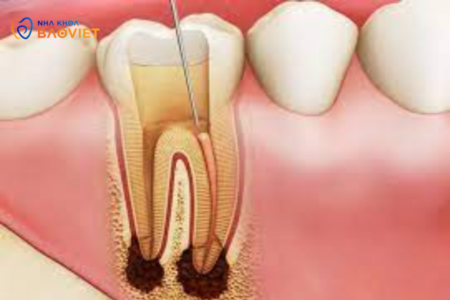 Viêm Tủy Răng Ngược: Nguy Cơ Và Biểu Hiện Cần Chú Ý