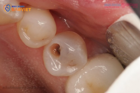 Viêm Tủy Răng Ngược: Nguy Cơ Và Biểu Hiện Cần Chú Ý