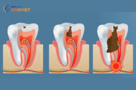 Viêm Tủy Răng Ngược: Nguy Cơ Và Biểu Hiện Cần Chú ÝViêm Tủy Răng Ngược: Nguy Cơ Và Biểu Hiện Cần Chú Ý