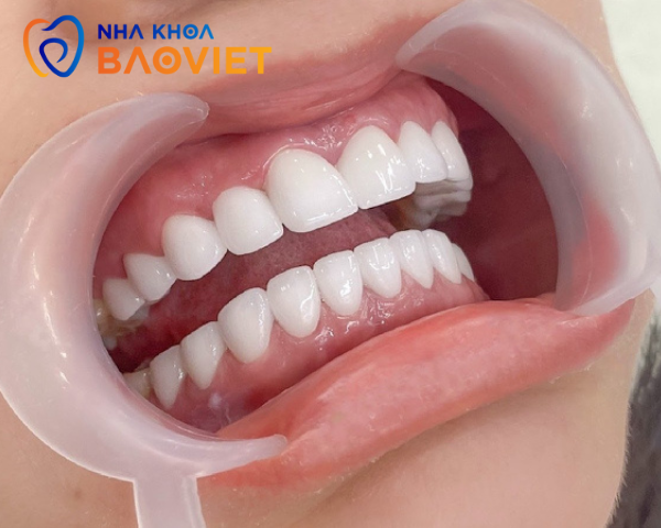 Bọc Răng Sứ Có Dễ Bị Xỉn Màu Không? Lý Do Và Phương Pháp Giữ Gìn Hiệu Quả
