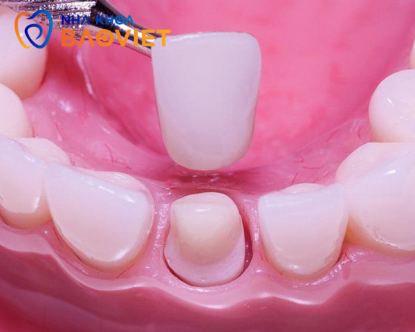 Bọc Răng Sứ Có Dễ Bị Xỉn Màu Không? Lý Do Và Phương Pháp Giữ Gìn Hiệu Quả
