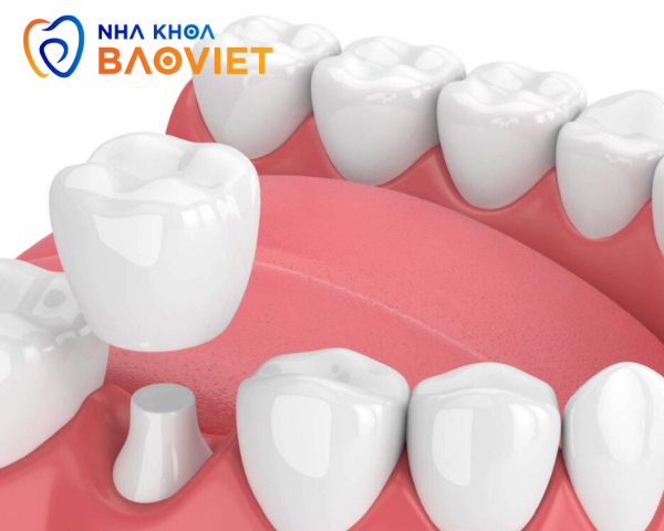 Bọc Răng Sứ Có Dễ Bị Xỉn Màu Không? Lý Do Và Phương Pháp Giữ Gìn Hiệu Quả