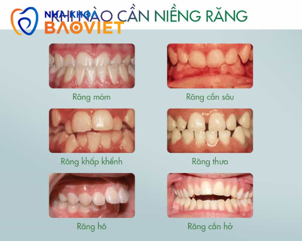 nieng rang khi nao