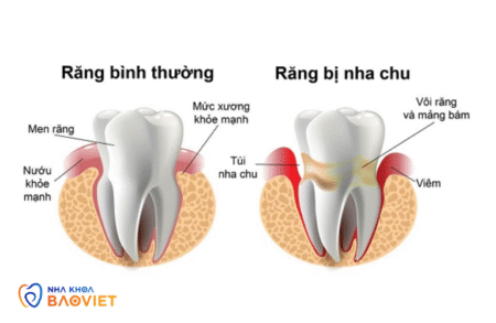 cao voi rang co tri duoc nha chu khong su that laho SFlr
