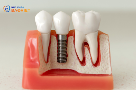 Implant