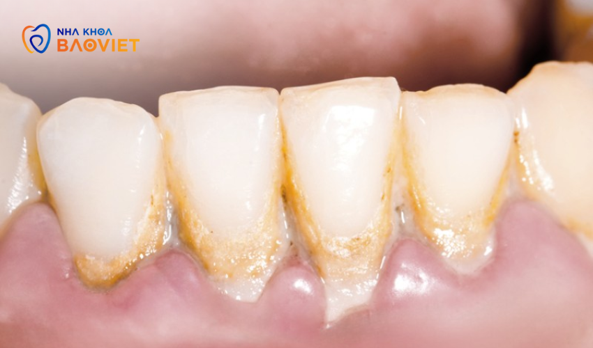 5 Dấu Hiệu Bệnh Nha Chu Cảnh Báo Bạn Cần Điều Trị Ngay