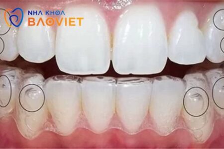 niềng răng khay Invisalign