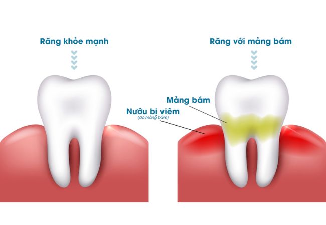 Mảng bám răng