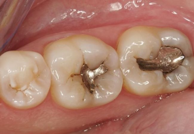 Điều trị tủy răng