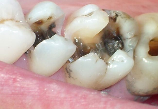 Điều trị tủy răng