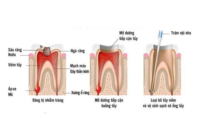 Điều trị tủy răng