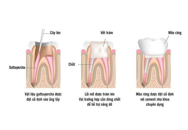 Điều trị tủy răng