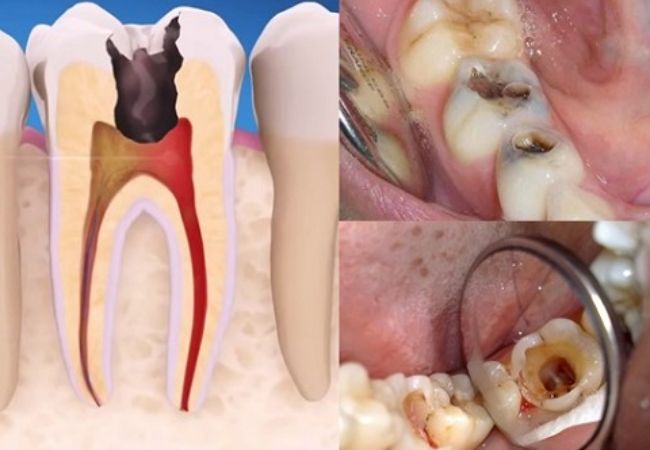 Điều trị tủy răng