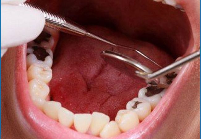 Điều trị tủy răng