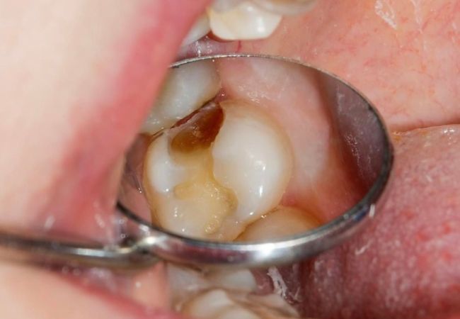 Điều trị tủy răng