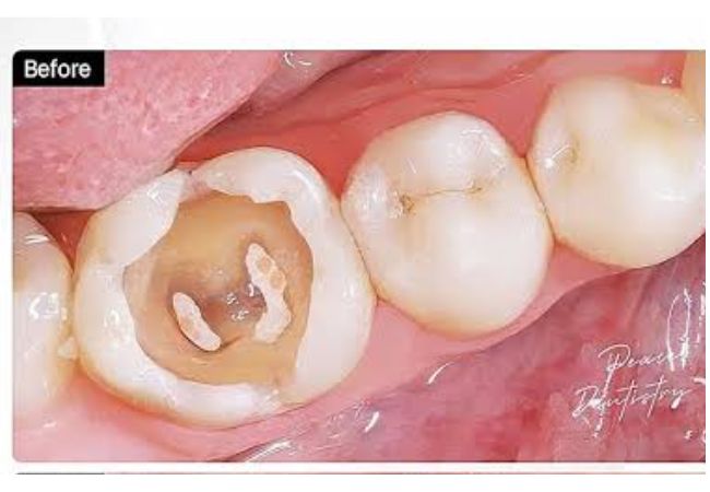 Điều trị tủy răng